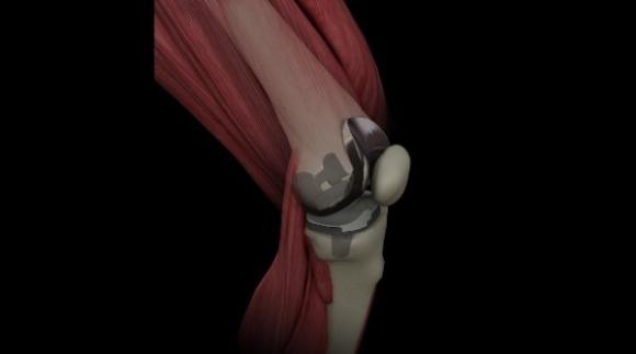 Desarrollan en Argentina una innovadora prótesis de revisión para reemplazo total de rodilla