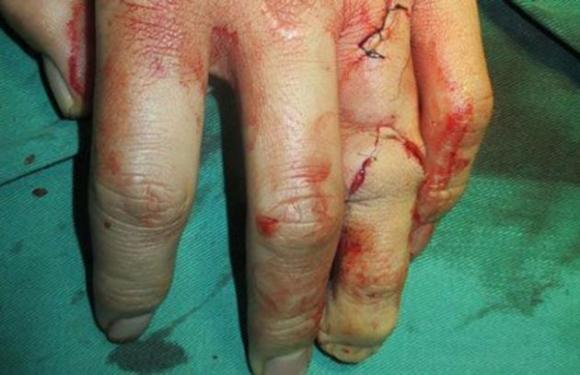 Le implantan un dedo del pie en su mano