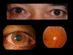 Investigadores Argentinos presentan nuevos avances sobre la isquemia ocular