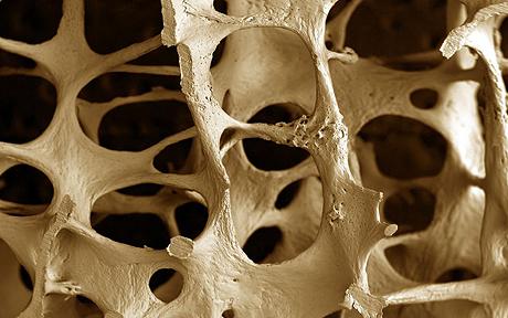 Uno de cada cinco hombres podría sufrir osteoporosis en la adultez