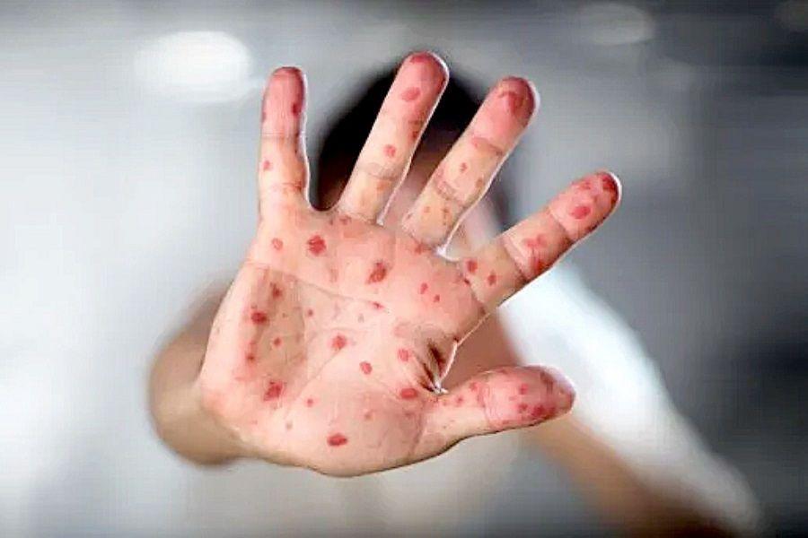 Viruela del mono: Ante los 9.200 casos la OMS convocó al Comité de Emergencia