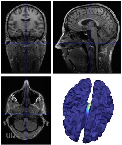 Cientificos Argentinos identifican un mecanismo que causa la epilepsia y la resistencia a la medicación
