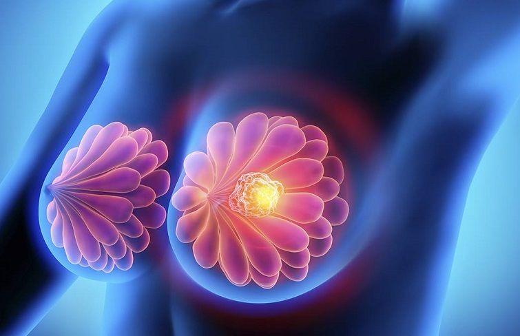 El cáncer de mama se propaga cuando se duerme