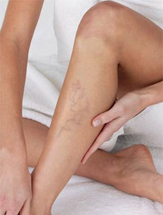 ICBA: Charla gratuita sobre várices