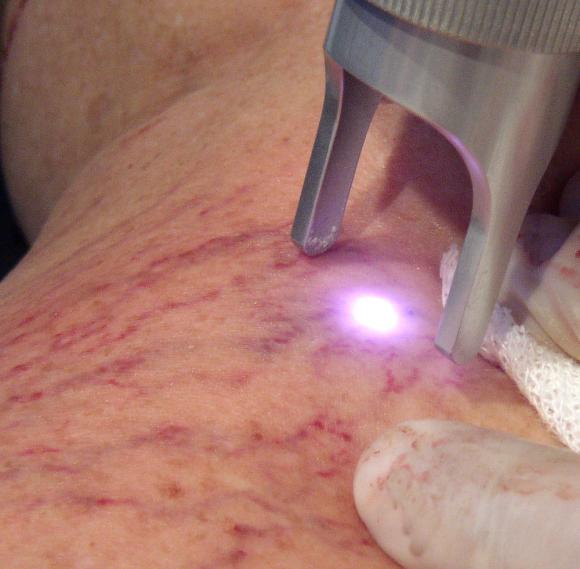 Escleroterapia en flebología estética.