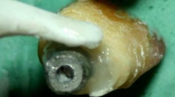Odontologa Argentina desarrolló un dispositivo que logra sacar el perno del diente sin desgastarlo