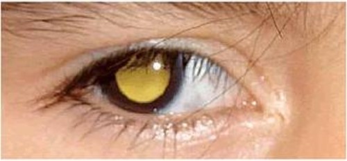 Medicos Argentinos confirman que el retinoblastoma en niños se cura si se diagnostica a tiempo