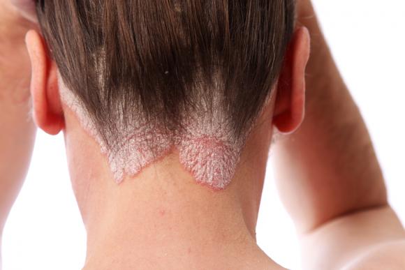 Nuevo fármaco para la psoriasis se muestra promisorio