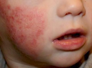 Taller para familiares de niños con dermatitis atópica