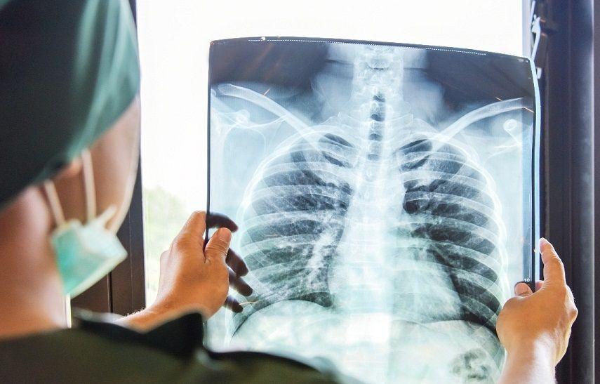 Hallan microplásticos en las vías respiratorias de los seres humanos