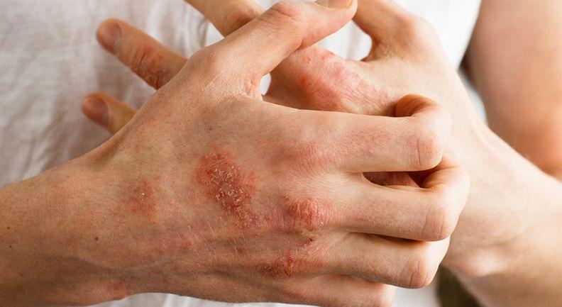 Campaña abierta para detectar y tratar a tiempo la esclerodermia