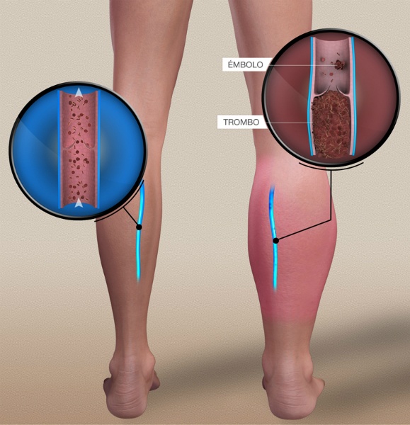 El Tromboembolismo Venoso puede prevenirse