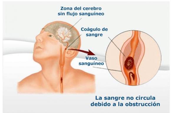 San Isidro: Recomiendan cómo prevenir un ataque cerebral