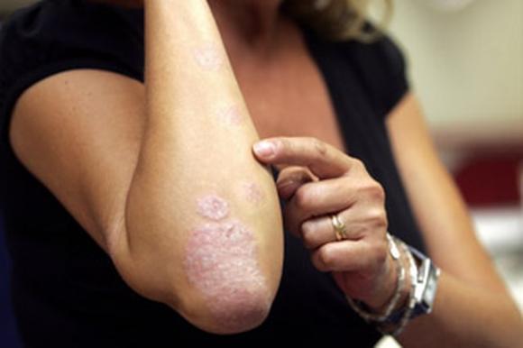 Vinculan a la psoriasis con enfermedades cardiometabólicas 