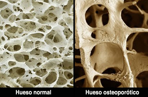 San Isidro: Charla gratuita sobre Osteoporosis