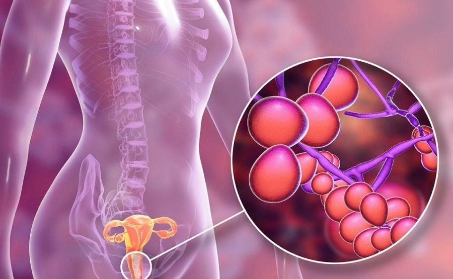 3 de cada 4 mujeres tendrán candidiasis vaginal alguna vez a lo largo de su vida