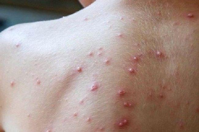 Confirmaron el sexto caso de viruela símica en Argentina