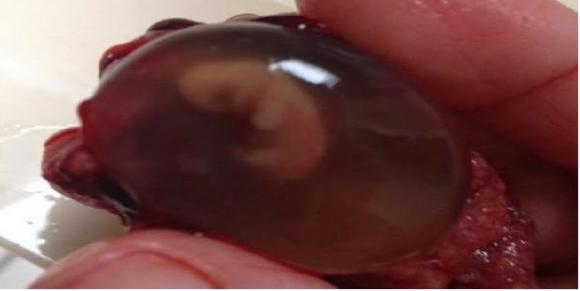 A los legisladores argentinos, 7 semanas de gestación: una imagen, un argumento científico e irrefutable contra el aborto