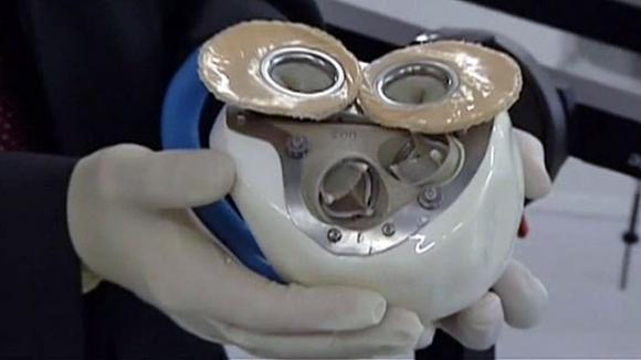 Segundo trasplantado con corazón artificial de Carmat ¨nunca se había sentido tan bien¨