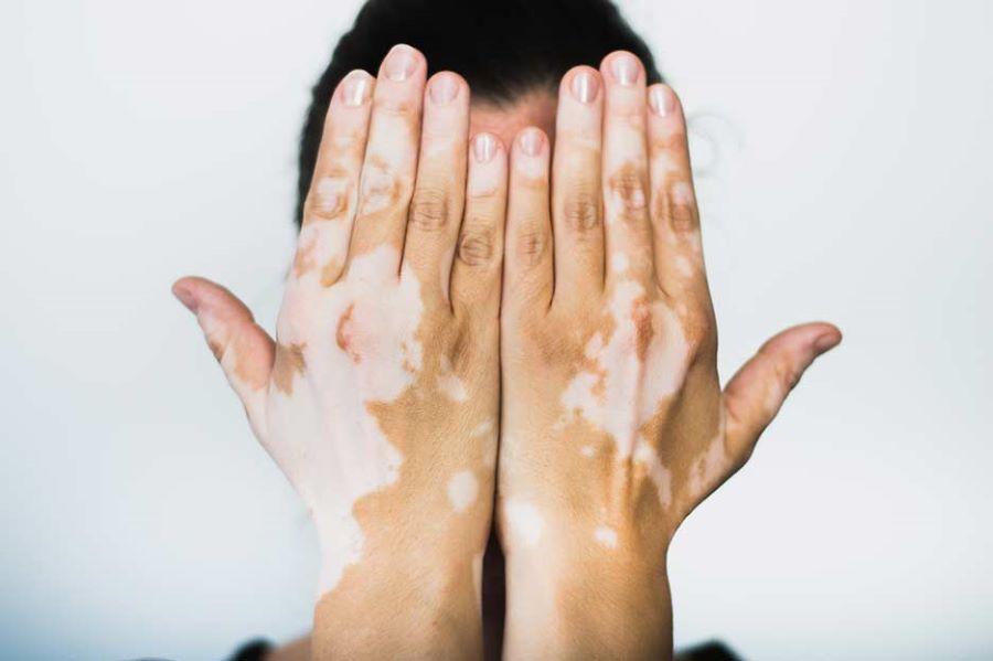 Esas distintivas manchas blancas: principal signo visible del vitíligo