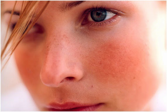 La rosácea se debería a la genética y al estilo de vida