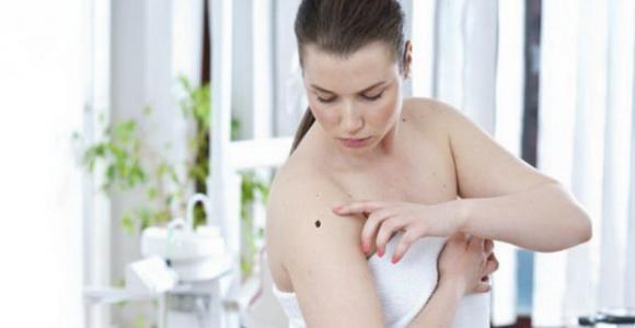 Destacan la importancia del autoexamen para detectar el melanoma