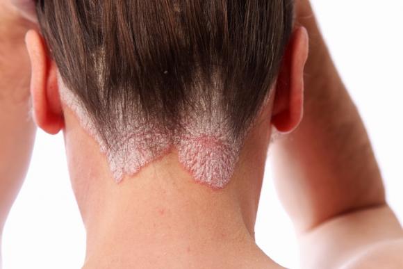 Aprueban medicación para psoriasis moderada a severa