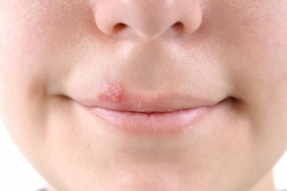Más del 60% de la población menor de 50 años sufre herpes