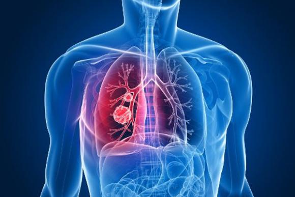 17-11 | Día Internacional del Cáncer de Pulmón