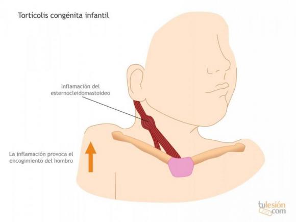 TORTÍCOLI CONGÉNITO