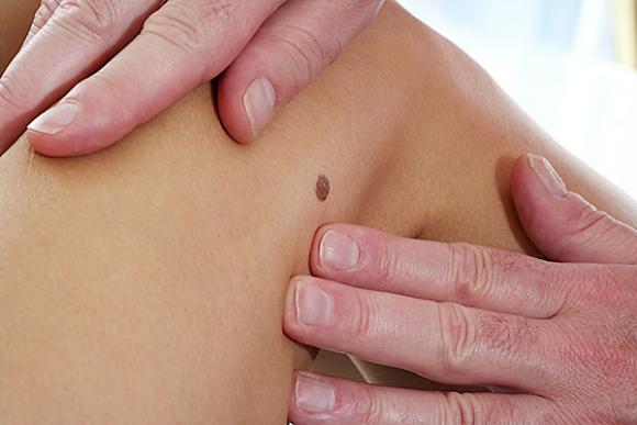 Lunares: cuándo consultar a un especialista