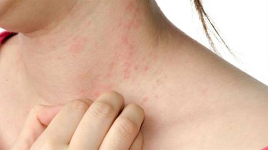 SI | Recomiendan cómo tratar la artritis psoriásica