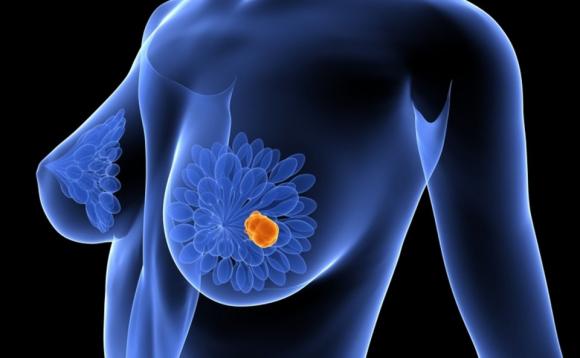 Llegó a la Argentina nueva droga para un subtipo de cáncer de mama
