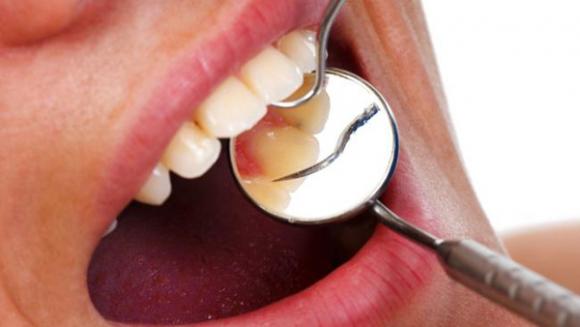 Una buena salud bucodental reduce el riesgo de ictus