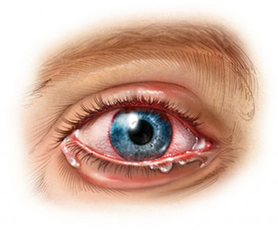 Crecen los casos de uveítis provocado por los tatuajes