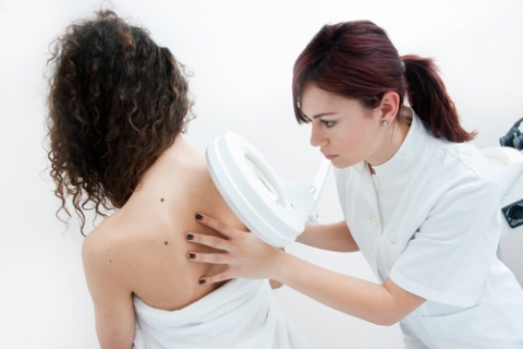 Melanoma: La mayoría de pacientes tiene pocos lunares