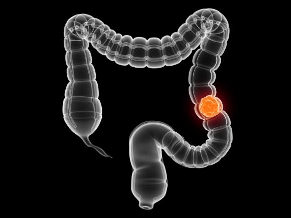Seis pasos para reducir el riesgo de cáncer de colon