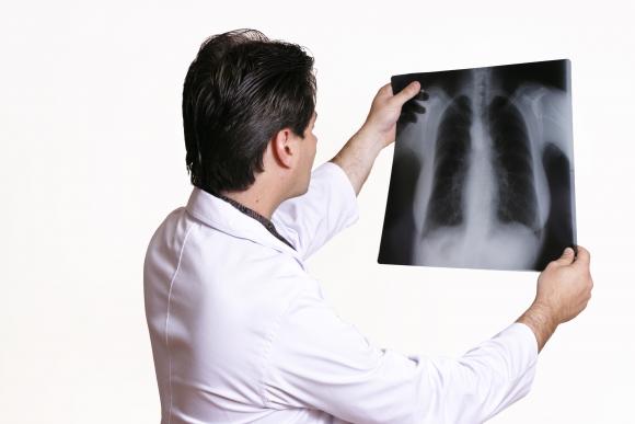24 de marzo: Día Mundial de la Tuberculosis