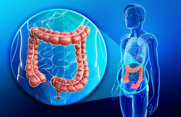 Mitos y verdades sobre el cáncer de colon