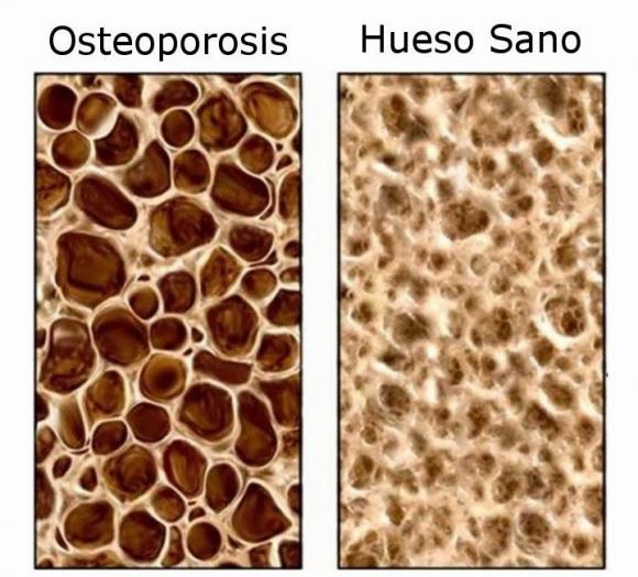 Relacionan al virus del HIV con la osteoporosis