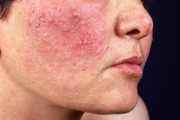La rosácea aumentaría el riesgo de Alzheimer
