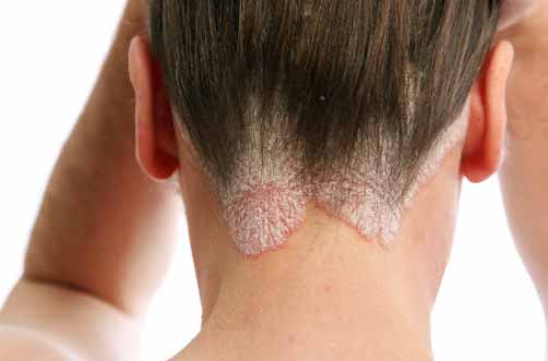 Psoriasis: Nuevos tratamientos muestran excelentes resultados