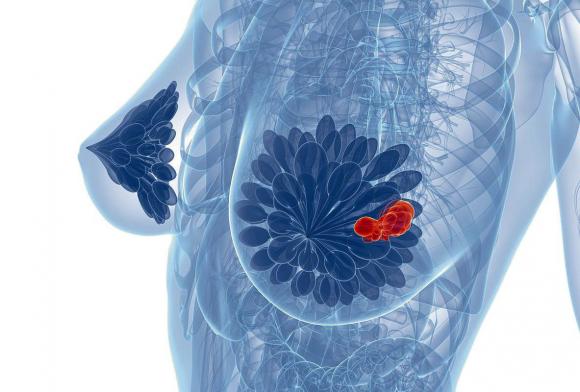 Nueva herramienta permite saber cuál es el riesgo de cáncer de mama 
