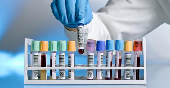 Depresión: Un simple test de sangre permite saber qué medicamento necesita cada paciente