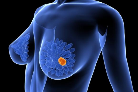 Fármaco previene el cáncer de mama asociado al BRCA1