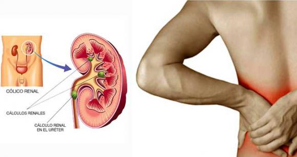 Lo último en cálculos renales: Mitos y realidades