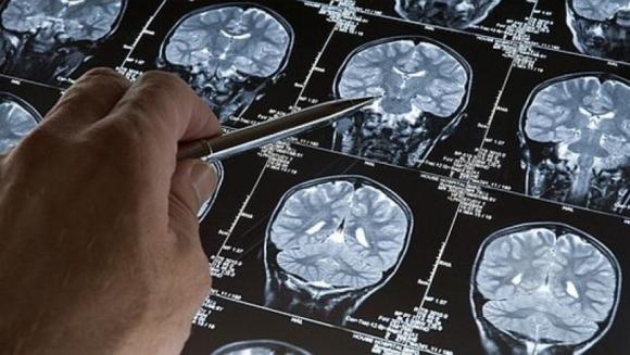 Buscan revelar la ¨firma molecular¨ del Alzheimer