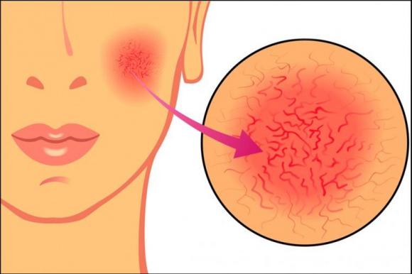 Rosácea: cuando ponerse colorado no es pasajero