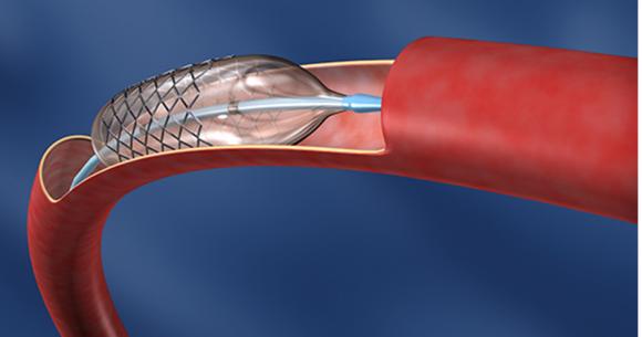 En el país se hacen entre 6 y 7 angioplastias por día en personas jóvenes