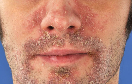 La psoriasis afecta la calidad de vida de muchos pacientes